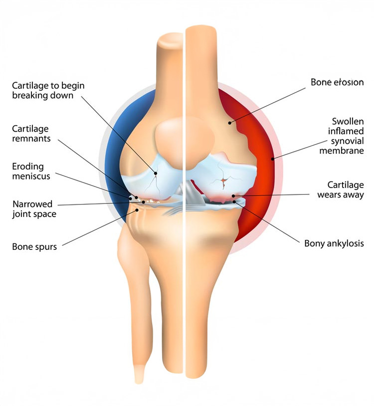osteoarthritis