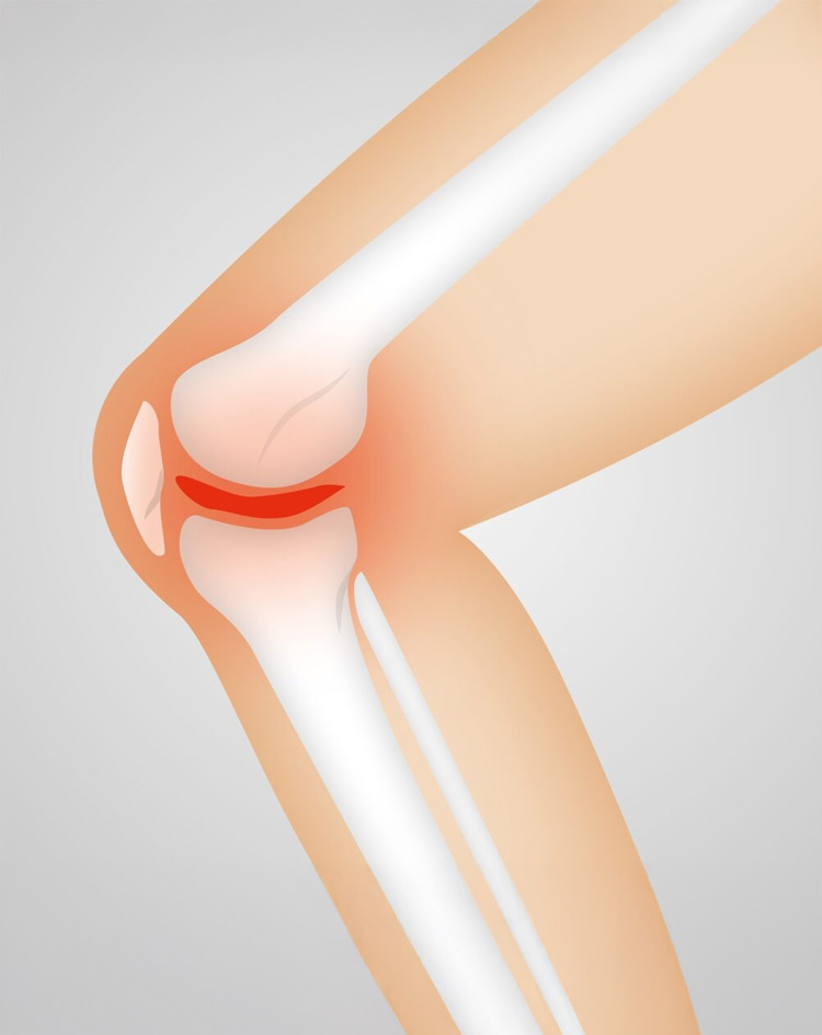 osteoarthritis