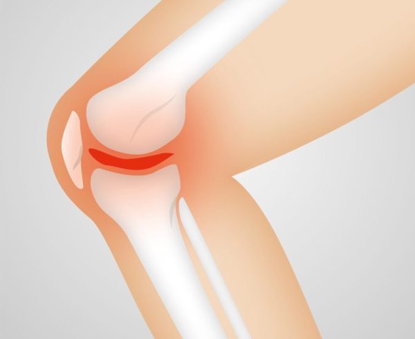 osteoarthritis